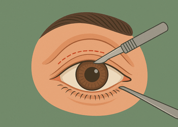 Chirurgia Palpebrale