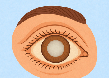 Chirurgia della Cataratta