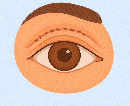 Chirurgia Palpebrale