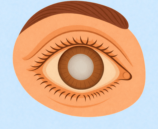 Chirurgia della Cataratta